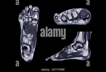 Imagerie par résonance Manetic du pied ou IRM DU PIED PDW vue axiale, coronale et sagittale pour diagnostic de lésion du tendon. Banque D'Images