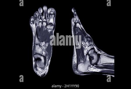 Imagerie par résonance Manetic du pied ou IRM DU PIED PDW vue axiale, coronale et sagittale pour diagnostic de lésion du tendon. Banque D'Images