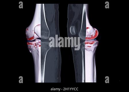 Comparer l'image de rendu 3D CT de l'articulation du genou et la vue sagittale CT du genou et la vue sagittale CT du genou 2D isolées sur fond noir montrant le tibia de fracture Banque D'Images