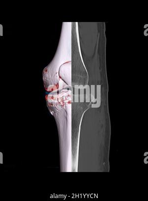Comparer l'image de rendu 3D de l'articulation du genou CT et l'image 2D du genou CT isolée sur fond noir montrant une fracture de l'os du tibia. Banque D'Images