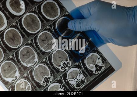 Neurochirurgien portant des gants médicaux bleus tient une série d'acquisitions CAT montrant la tête humaine.Examen, traitement.Tomographie, IRM, rayons X. Banque D'Images
