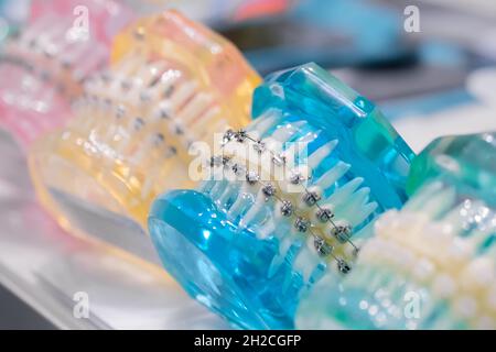 Mâchoires humaines transparentes avec support orthodontique, entretoises en métal et en céramique Banque D'Images