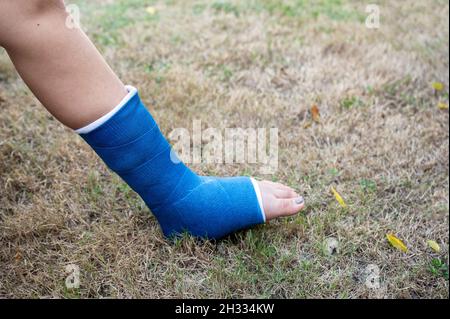 Jeune femme accident avec fracture osseuse pied dans plâtre moulé Banque D'Images