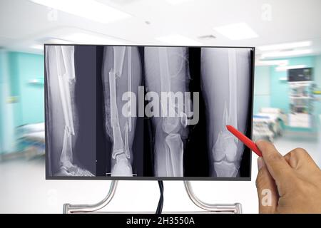 Gros plan X-ray os entier de jambe montrant la fracture multiples fractures osseuses, Docteur tenant un point rouge de plume, symptômes concept de santé médicale. Banque D'Images