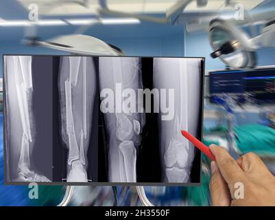 Gros plan X-ray os entier de jambe montrant la fracture multiples fractures osseuses, Docteur tenant un point rouge de plume, symptômes concept de santé médicale. Banque D'Images