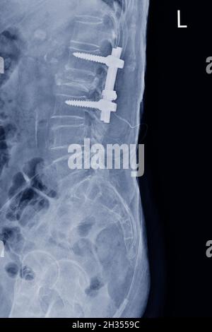 Film X-ray LS-rachis vue latérale montrant rupture en rafale du corps vertébral L2 avec plaque de post-opération et vis, concept d'image médicale. Banque D'Images