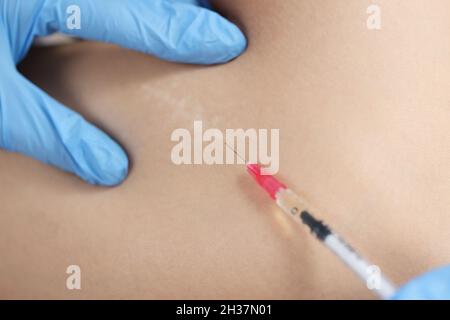 Médecin injectant des médicaments dans la zone de cicatrice postopératoire sur la peau de gros plan Banque D'Images