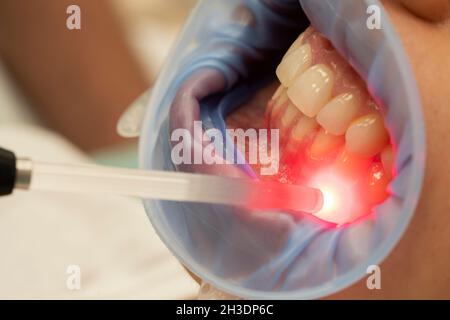 Soins dentaires avec lumière LED rouge dans le cabinet dentaire Banque D'Images