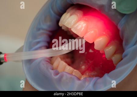 Soins dentaires avec lumière LED rouge dans le cabinet dentaire Banque D'Images