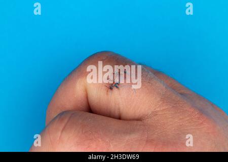 Sutures postopératoires sur le doigt de la main.Points de suture sur le doigt blessé.Photo prise sous lumière artificielle Banque D'Images