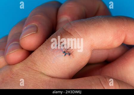 Sutures postopératoires sur le doigt de la main.Points de suture sur le doigt blessé.Photo prise sous lumière artificielle Banque D'Images