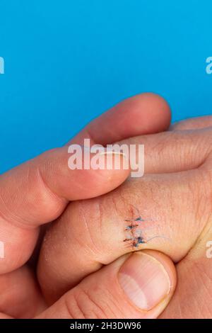 Sutures postopératoires sur le doigt de la main.Points de suture sur le doigt blessé.Photo prise sous lumière artificielle Banque D'Images