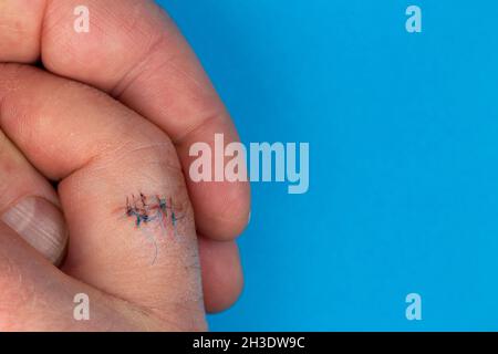 Sutures postopératoires sur le doigt de la main.Points de suture sur le doigt blessé.Photo prise sous lumière artificielle Banque D'Images