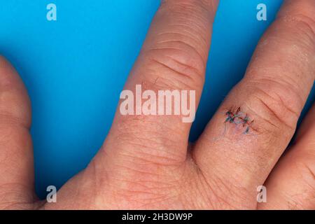 Sutures postopératoires sur le doigt de la main.Points de suture sur le doigt blessé.Photo prise sous lumière artificielle Banque D'Images