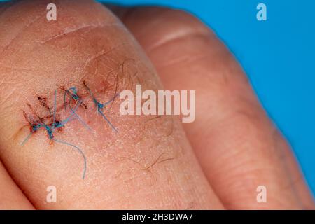 Sutures postopératoires sur le doigt de la main.Points de suture sur le doigt blessé.Photo prise sous lumière artificielle Banque D'Images