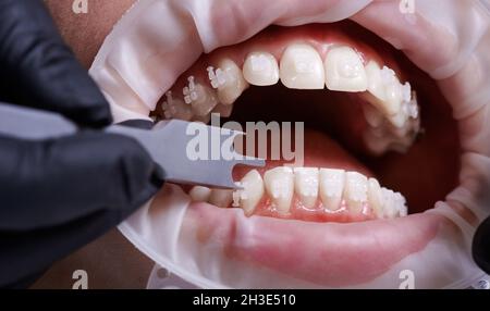 Gros plan de l'orthodontiste à l'aide d'une jauge de support en aluminium tout en fixant les bretelles aux dents du patient.Personne ayant un rétracteur de joue dans la bouche et des supports orthodontiques sur les dents ayant une intervention dentaire en clinique. Banque D'Images