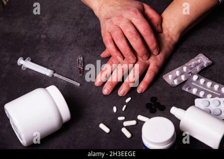 Les mains avec une dermatite allergique, problèmes dermatologiques. Le mal de peau. Médicaments, comprimés, seringue, ampoule, crème pour le traitement des allergies. Bliste Banque D'Images