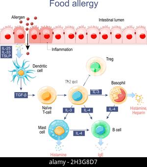 Allergie alimentaire.Inflammation de l'intestin.Allergènes, histamine et cellules immunitaires, qui libèrent la réaction allergique. Illustration de Vecteur