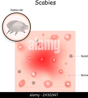 Gale. Infestation contagieuse de la peau.Gros plan de l'acarien de la gale et de la peau de l'homme avec vue agrandie d'un sentier de terriers de l'acarien. Illustration de Vecteur