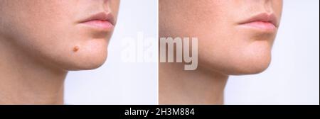 Femme visage avant et après l'enlèvement de mole.Traitement au laser pour l'élimination du signe de naissance du visage du patient. Banque D'Images