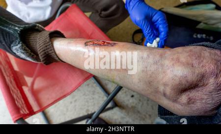 blessure transformée en ulcère variqueux sur une jambe qui doit être guérie quotidiennement Banque D'Images