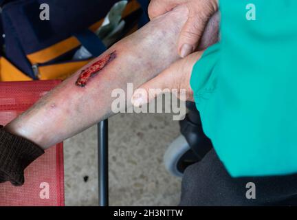 blessure transformée en ulcère variqueux sur une jambe qui doit être guérie quotidiennement Banque D'Images