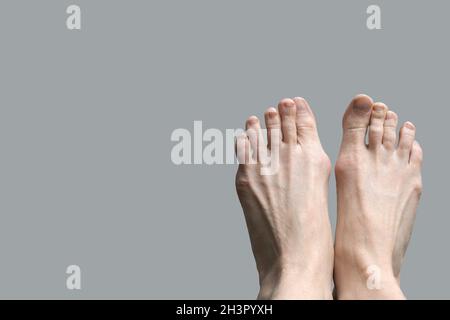 Hallux valgus, bursite du pied sur fond gris.Déformation des articulations du pied.Le problème des soins de santé et de la médecine avec le huma Banque D'Images