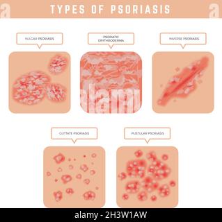 Types de psoriasis.Problèmes de peau gros plan illustrations médicales ensemble de vecteurs Illustration de Vecteur
