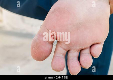 Pied de l'athlète - tinea pedis, infection fongique ou la semelle des pieds avec la dermatite, le sujet est mou foyer Banque D'Images