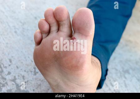 Pied de l'athlète - tinea pedis, infection fongique ou la semelle des pieds avec la dermatite, le sujet est mou foyer Banque D'Images