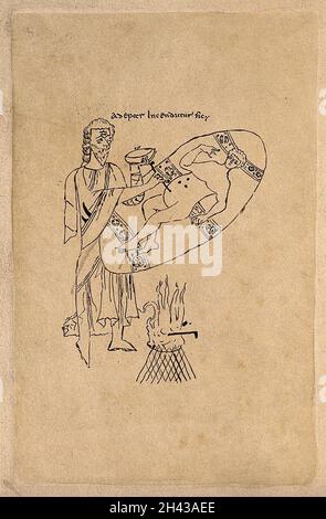 Un chirurgien appliquant un fer cautérique à des points clairement définis sur le bas de l'abdomen d'une femme (indiquant le foie ?).Dessin au stylo après un manuscrit du dixième siècle. Banque D'Images