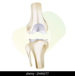 Lésion du cartilage du genou - Illustration comme fichier EPS 10 Illustration de Vecteur