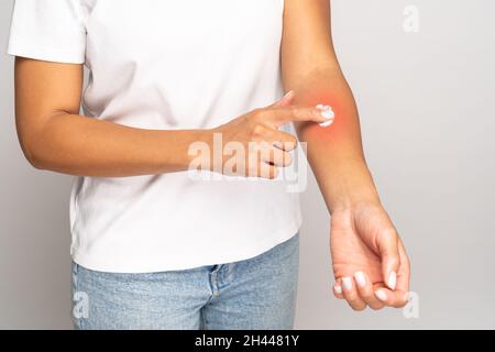 Femelle appliquant de la crème sur la peau de houle après des piqûres d'insectes, isolé sur fond gris studio. Allergie. Banque D'Images