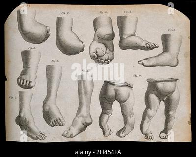 Pieds et chevilles d form s 10 chiffres.Gravure en ligne et