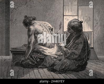 Un médecin japonais appliquant de la moxa (une substance produite à partir de feuilles de divers bois de vermillepertuis) comme une cautérisation : l'enflammer sur la peau du dos d'un patient.Gravure en bois. Banque D'Images