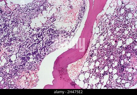 Lymphome non hodgkinien avec SIDA : moelle osseuse Banque D'Images