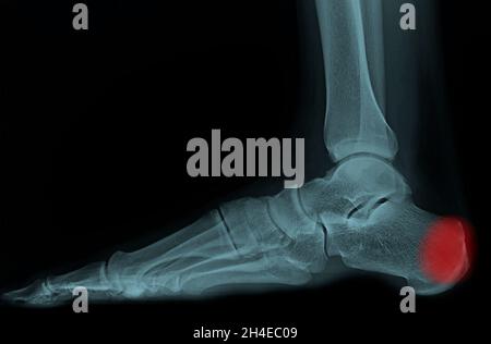 Rayons X latéraux du pied et de la cheville. Le film montre un os et une articulation normaux. Le patient a une tendinite d'Achille et une bursite rétrocalcanéale. Banque D'Images