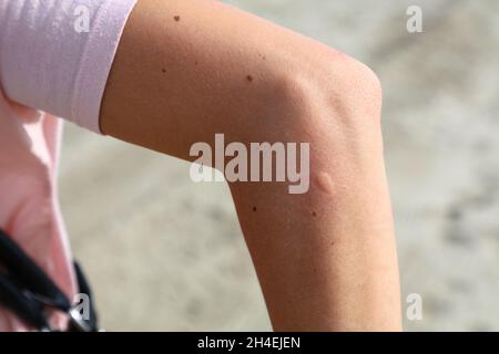 Moustique morsure peau irritée sur le bras de la femme. Banque D'Images
