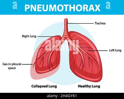 Schéma pneumothorax avec poumon collabé et poumon sain Illustration de Vecteur