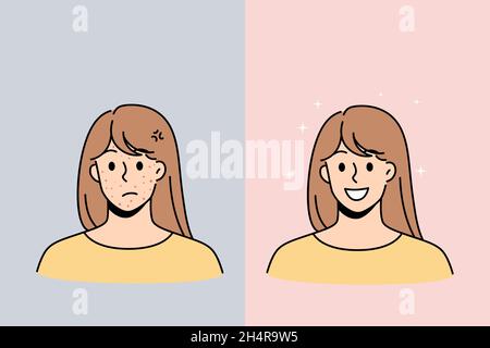 Problème de peau et concept de santé.Jeune femme stressée malheureuse avec des boutons d'acné rouge et souriant avec la peau saine visage illustration vecteur Illustration de Vecteur