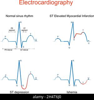 Électrocardiogramme.ECG ou EKG d'un cœur avec un rythme sinusal normal, infarctus du myocarde avec sus-décalage du segment ST, Ishemia, sous-décalage du segment ST et comparaison Illustration de Vecteur