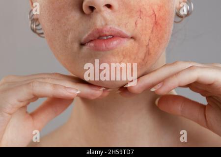 Cosmétologie et rosacée.Portrait de la moitié du visage d'une femme.Mains au menton, une joue avec la rosacée sévère et l'inflammation.Gros plan. Banque D'Images