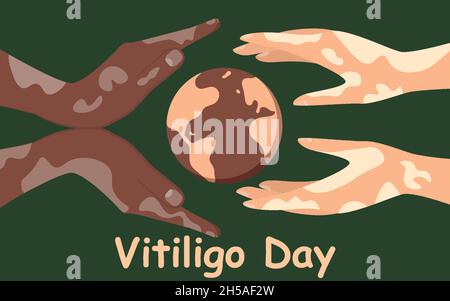 Affiche de la journée mondiale de Vitiligo.Mains de différentes nationalités avec des maladies de la peau.Solidarité humaine. Illustration de Vecteur