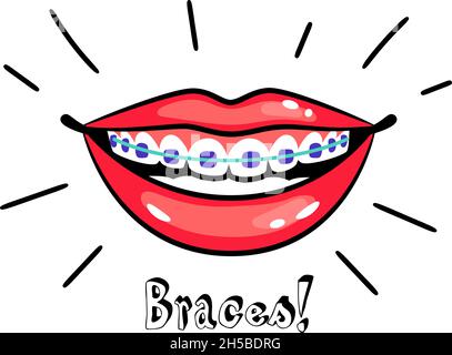 Bretelles orthodontiques.Un sourire de dessin animé avec des appareils dentaires, une bonne morsure des dents, une illustration vectorielle de l'alignement orthodontique médical et un traitement des dents dans la bouche Illustration de Vecteur