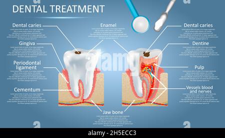 Schéma vectoriel de traitement dentaire éducation anatomie médicale affiche infographiques Illustration de Vecteur
