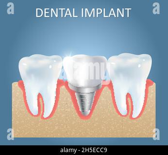 Modèle d'affiche médicale vecteur d'implant dentaire Illustration de Vecteur