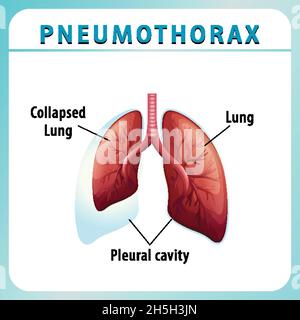 Schéma pneumothorax avec poumon collabé et poumon sain Illustration de Vecteur