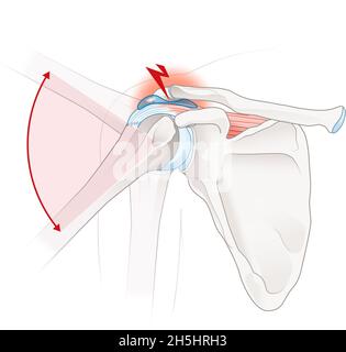 Illustration montrant un impact sur l'épaule Banque D'Images