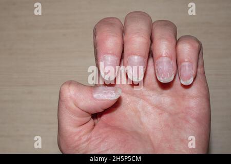 Gros plan des ongles mordus et fragiles sans manucure.Photo macro des crêtes verticales des ongles.Ongles de cuticule surcultivés et ongles contaminés Banque D'Images