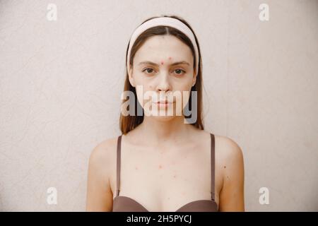 Portrait d'une jeune femme avec la varicelle couché au lit et mesurant la température. Banque D'Images